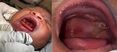 Case Report: A rare case of bilateral molar natal teeth in a term newborn